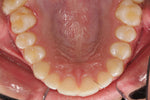 Lade das Bild in den Galerie-Viewer, OCCLUSAL STANDARD - lip and cheek retractor
