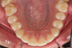 Load image into Gallery viewer, OCCLUSAL STANDARD - lip and cheek retractor
