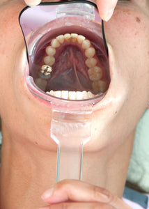 ECRAN OCCLUSAL K&K