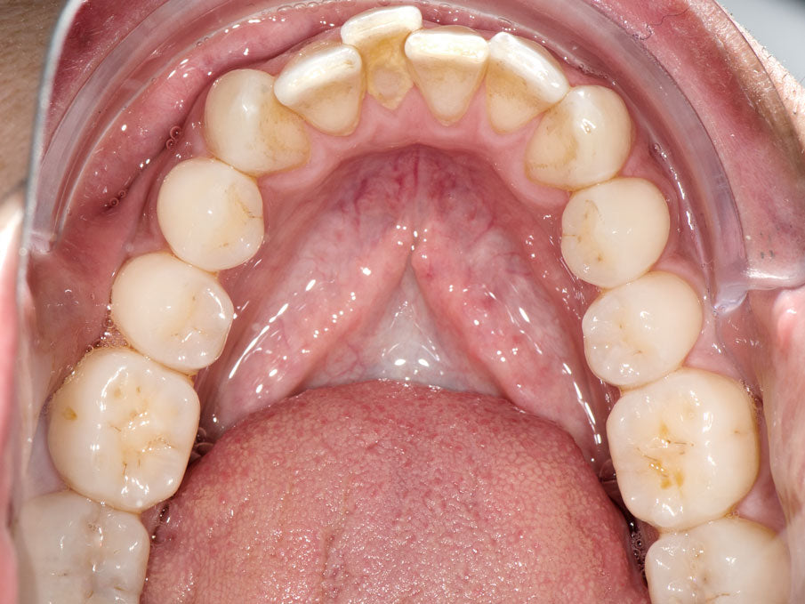 K&K OCCLUSAL RETRACTOR