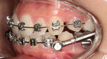 Charger l&#39;image dans la galerie, MAXEE - double ended retractor
