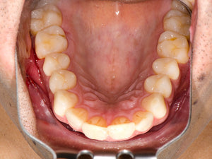 ÉCARTEUR OCCLUSAL 45