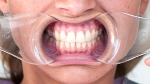 OCCLUSAL STANDARD - écarteur lèvres et joues