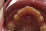 Load image into Gallery viewer, K&amp;K OCCLUSAL RETRACTOR
