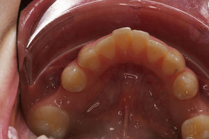 ECRAN OCCLUSAL K&K