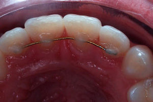 ECRAN OCCLUSAL K&K