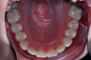 ECRAN OCCLUSAL K&K