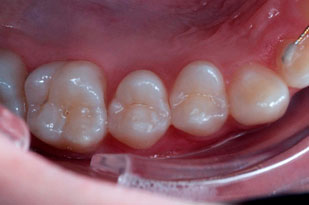 ECRAN OCCLUSAL K&K