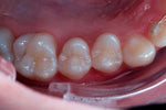 Charger l&#39;image dans la galerie, ECRAN OCCLUSAL K&amp;K
