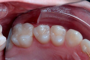 ECRAN OCCLUSAL K&K