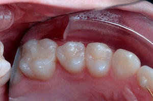 ECRAN OCCLUSAL K&K